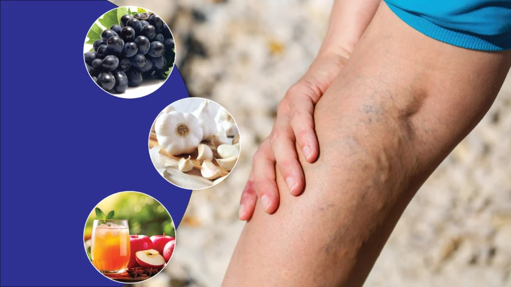 Understanding and Managing Varicose Veins